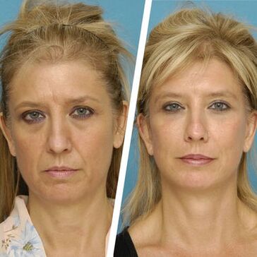 Die Erfahrung von Natalia da Kiew, Fotos vor und nach der Verwendung von Intenkin