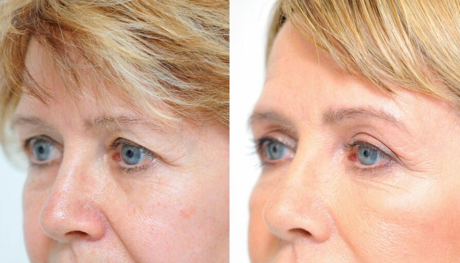Blepharoplastik-vorher-nachher
